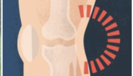 Back knee pain